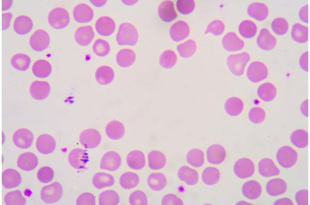 anisocytosis-causes-diagnosis-treatment-more